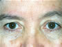 Eyelid Surgery Before picture