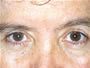 Eyelid Surgery After picture