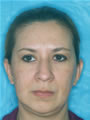 Brow Lift Before picture