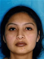 Nasal Sculpting After picture