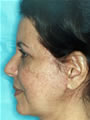 Nasal Sculpting Before picture