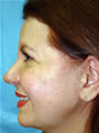 Nasal Sculpting After picture
