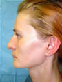 Nasal Sculpting Before picture