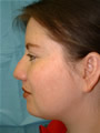 Nasal Sculpting Before picture