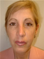Nasal Sculpting After picture