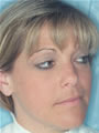 Nasal Sculpting Before picture