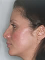 Nasal Sculpting Before picture