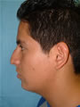 Nasal Sculpting Before picture