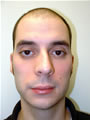 Nasal Sculpting Before picture
