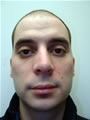 Nasal Sculpting After picture