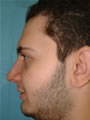 Nasal Sculpting After picture