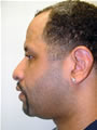 Nasal Sculpting Before picture