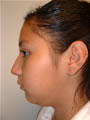 Nasal Sculpting Before picture