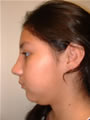 Nasal Sculpting After picture