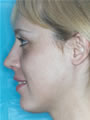 Nasal Sculpting After picture