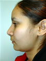 Nasal Sculpting After picture