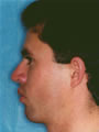 Nasal Sculpting After picture