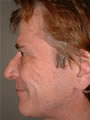 Nasal Sculpting Before picture