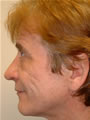 Nasal Sculpting After picture