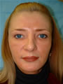 Nasal Sculpting and Fat Injection After picture