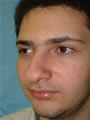 Nasal Sculpting Before picture