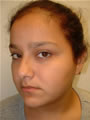 Nasal Sculpting Before picture