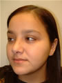 Nasal Sculpting After picture
