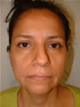 Nasal Sculpting Before picture