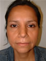 Nasal Sculpting After picture