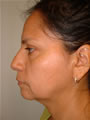 Nasal Sculpting Before picture