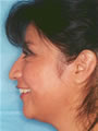 Nasal Sculpting and Chin Liposuction Before picture