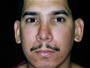 Otoplasty Before picture